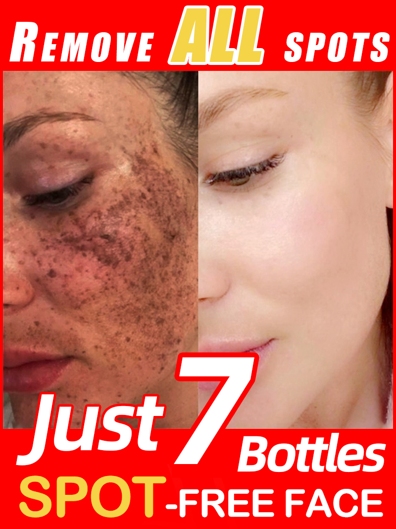 Ultra Luxury Skincare - Lighten Freckles Melasma, Facial Dark Spots